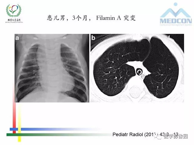 間質(zhì)性肺病最新特效藥研發(fā)進(jìn)展與應(yīng)用探索